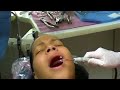 Physics Forceps Tooth Extraction
