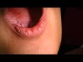 Physics Forceps Tooth Extraction