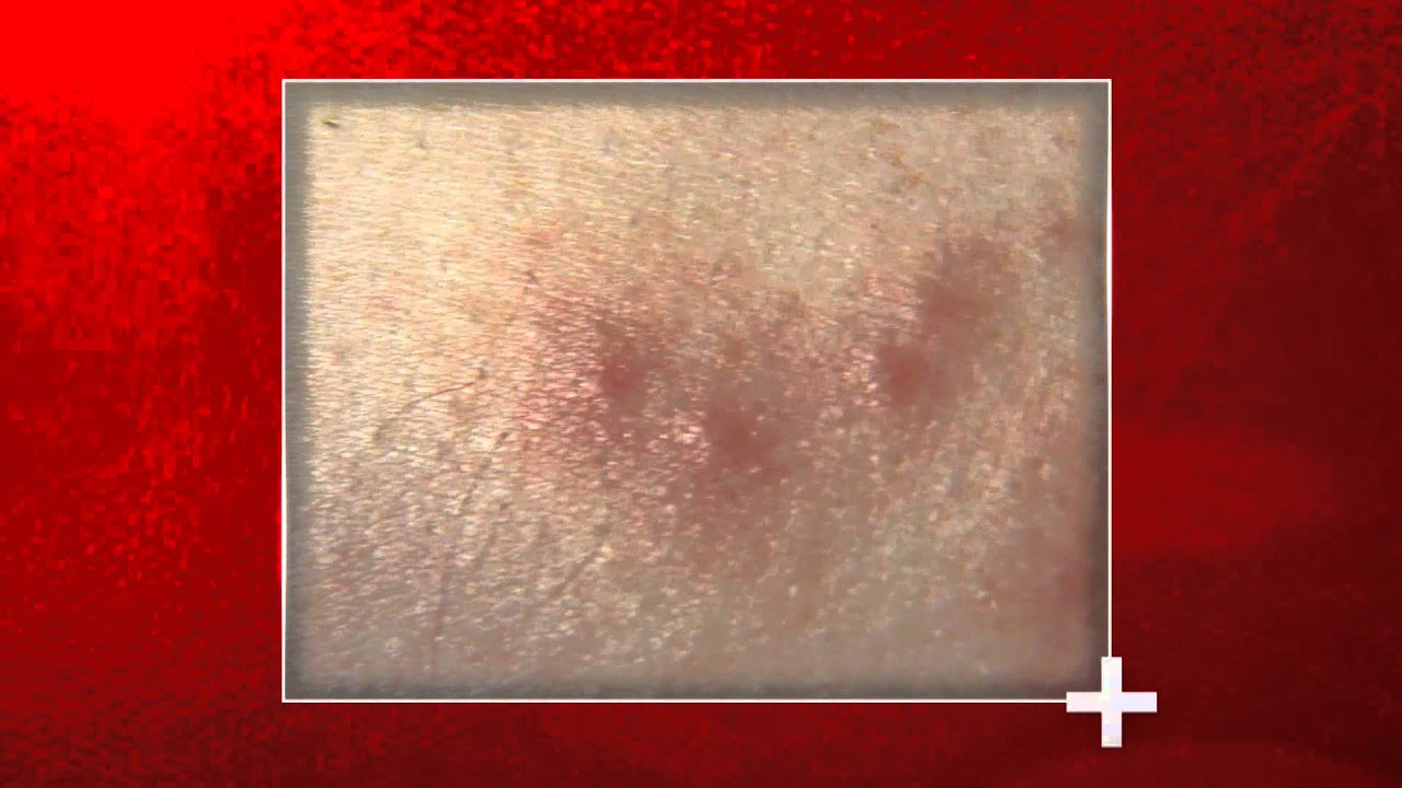 Signs of Bed Bug Bites - Health Checks - YouTube