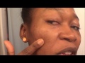 NATURAL REMEDIES TO TREAT MY ACNE, ACNE SCARS and SKIN DISCOLORATIONS