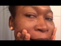 NATURAL REMEDIES TO TREAT MY ACNE, ACNE SCARS and SKIN DISCOLORATIONS