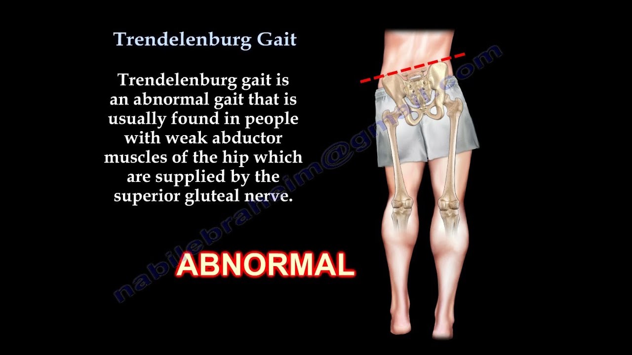 Trendelenburg Gait - Everything You Need To Know - Dr. Nabil Ebraheim