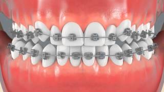 orthodontic options for crowded teeth