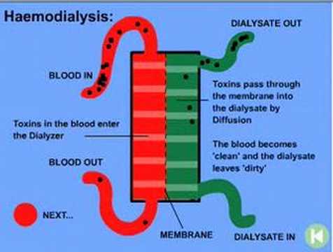 hemodialysis