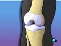 PreOp® Patient Education Arthroscopic Meniscus Repair, Knee