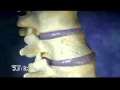 انواع كسور العظام  