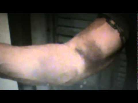 Torn bicep bicep tear blown bicep. - YouTube