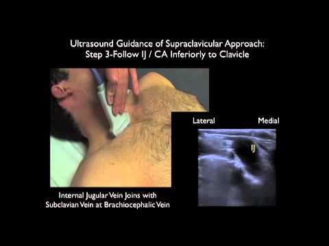 How To: Supraclavicular Approach to Subclavian Vein Cannulation