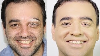 COBRINDO VITILIGO COM MAQUIAGEM