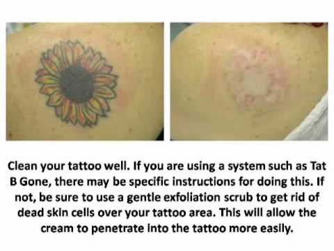 How to Remove a Tattoo With Home Remedies - Tattoo Removal Ideas ...