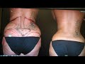 Video: Brazilian Butt Lift -Before and After pictures