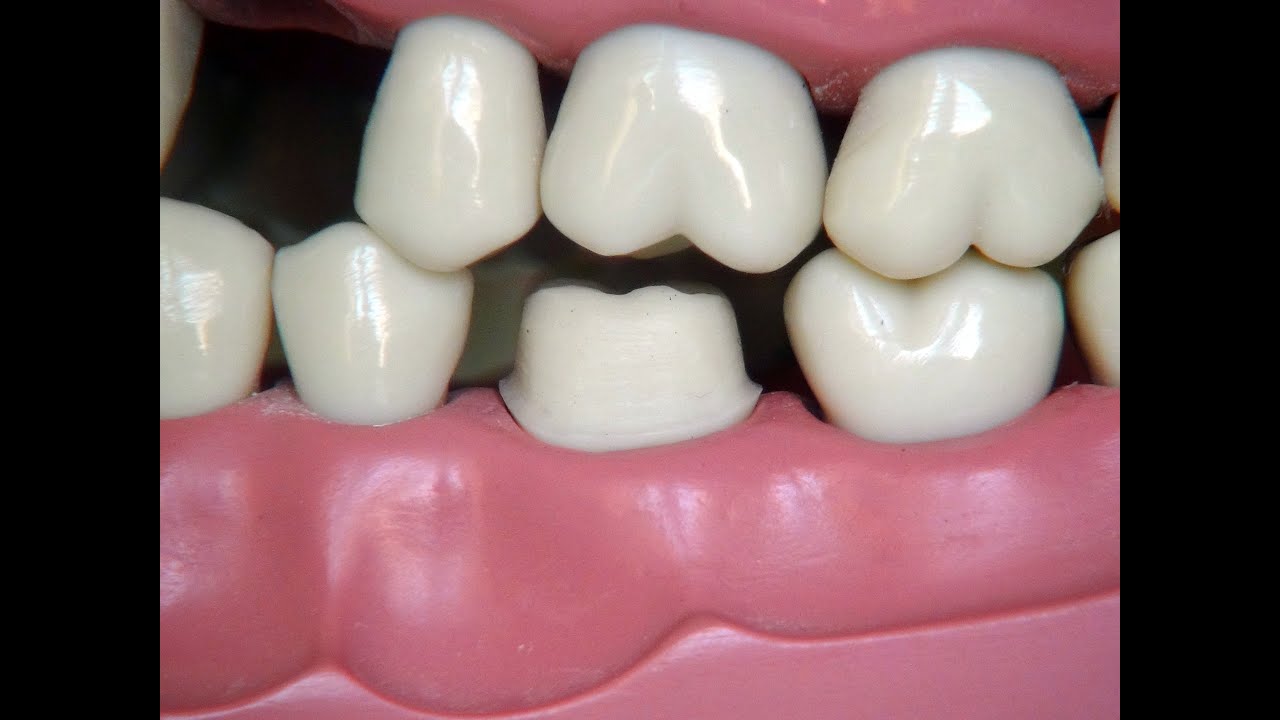 Full metal crown preparation - for dental students - YouTube