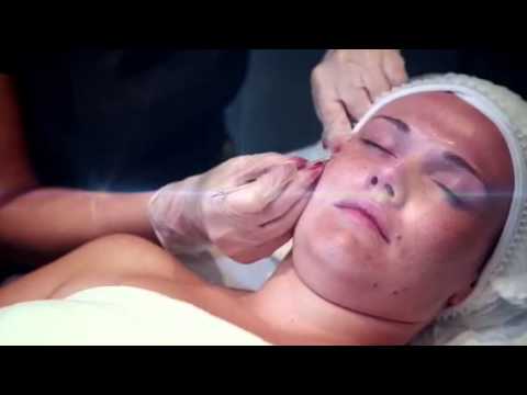 milia removal youtube milia removal youtube