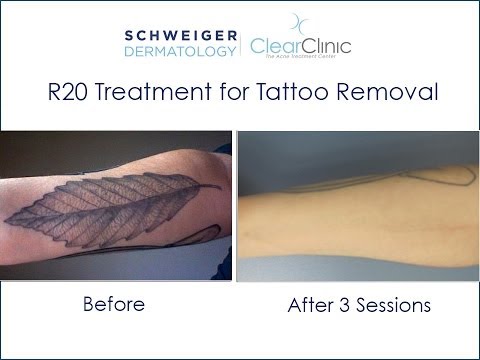 Laser Tattoo Removal -- R-20 Multi Pass Technique