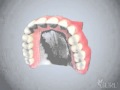 Prothèse dentaire complète amovible (dentier)