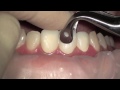 Tooth preparation under microscope, root canal treatment. Nazariy Mykhaylyuk