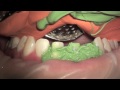 Tooth preparation under microscope, root canal treatment. Nazariy Mykhaylyuk