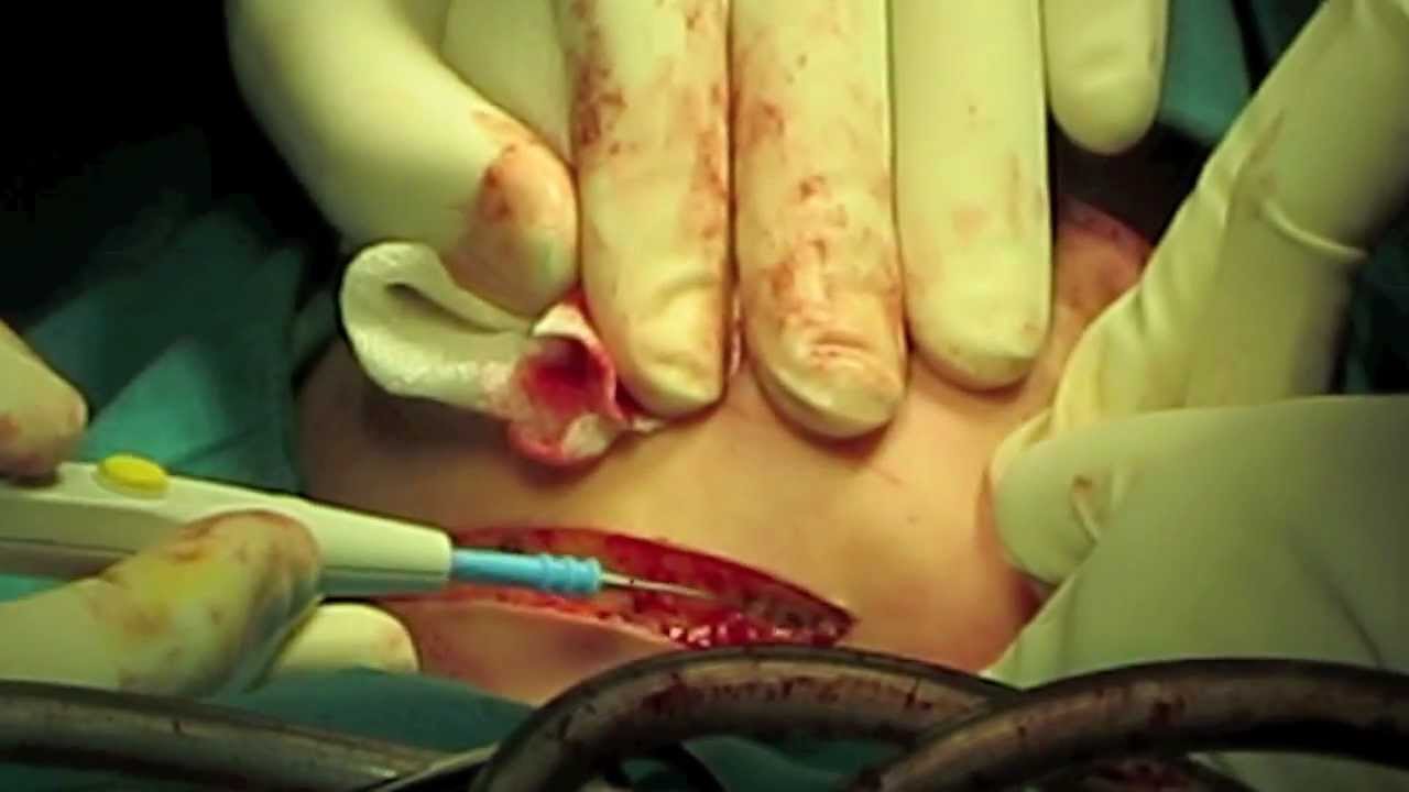 Partial Mandibulectomy & Reconstruction with Iliac Crest Bone Graft