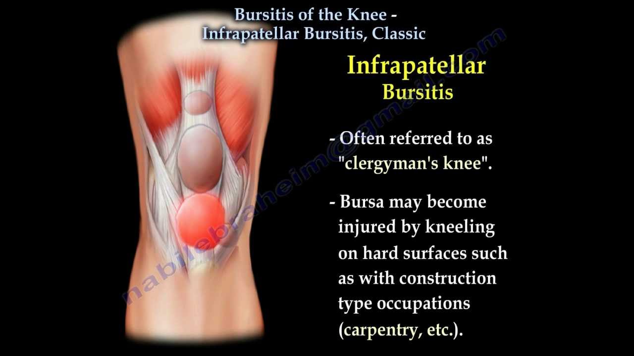 Knee Bursitis Infrapatellar Bursitis Classic Everything You Need To Know Dr Nabil Ebraheim 2609