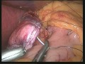 GASTROPLASTIA Y ROUX NA OBESIDADE MÓRBIDA (bypass)- COMO EU FAÇO -DR. NILTON ARANHA.mpg