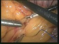 GASTROPLASTIA Y ROUX NA OBESIDADE MÓRBIDA (bypass)- COMO EU FAÇO -DR. NILTON ARANHA.mpg
