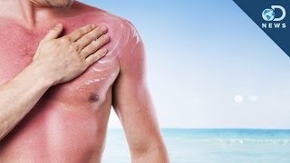 How Many Sunburns Can Cause Skin Cancer?