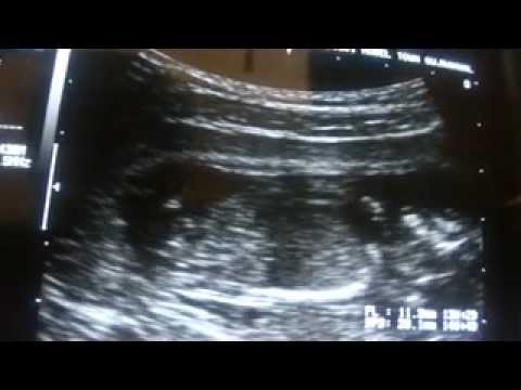 ultrasound of 14 weeks pregnancy with placenta MARGINAL ...