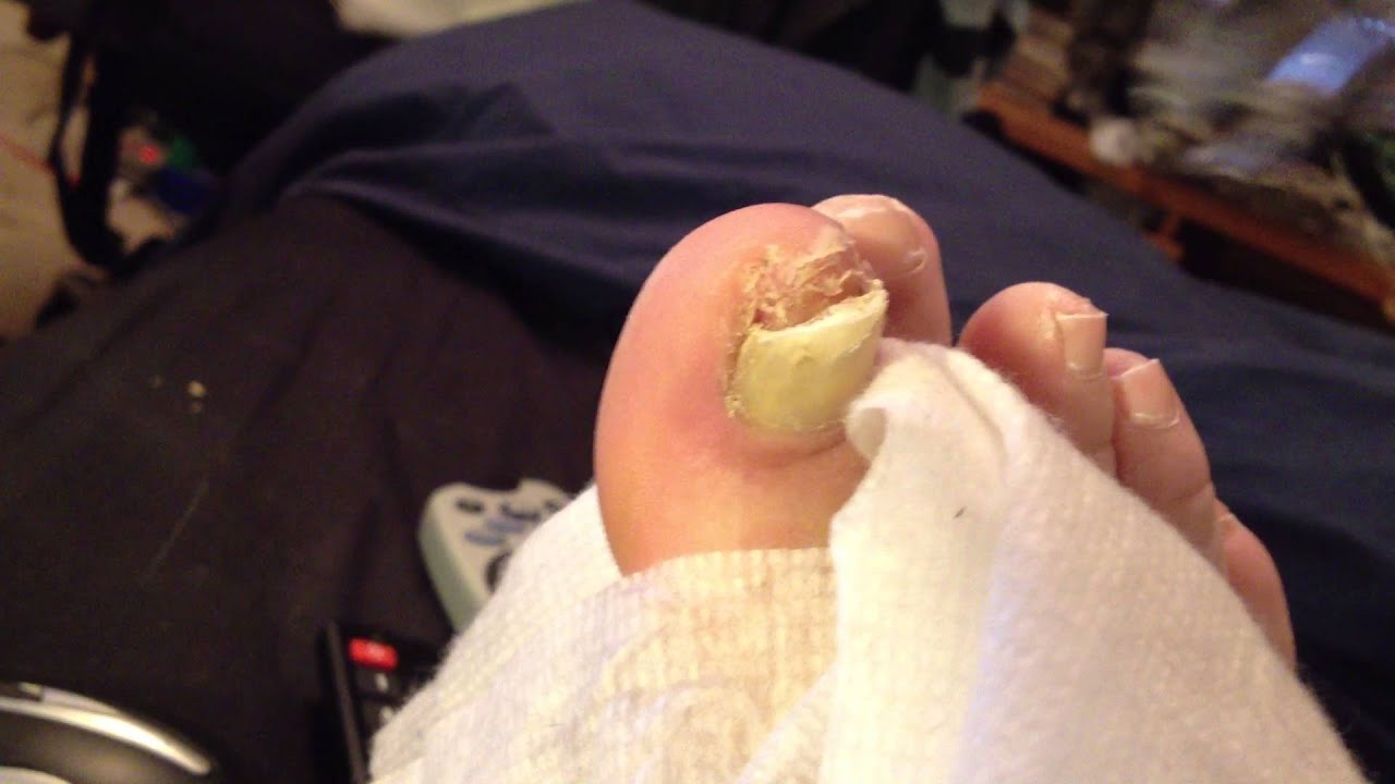YUCK big toe nail Problems - YouTube