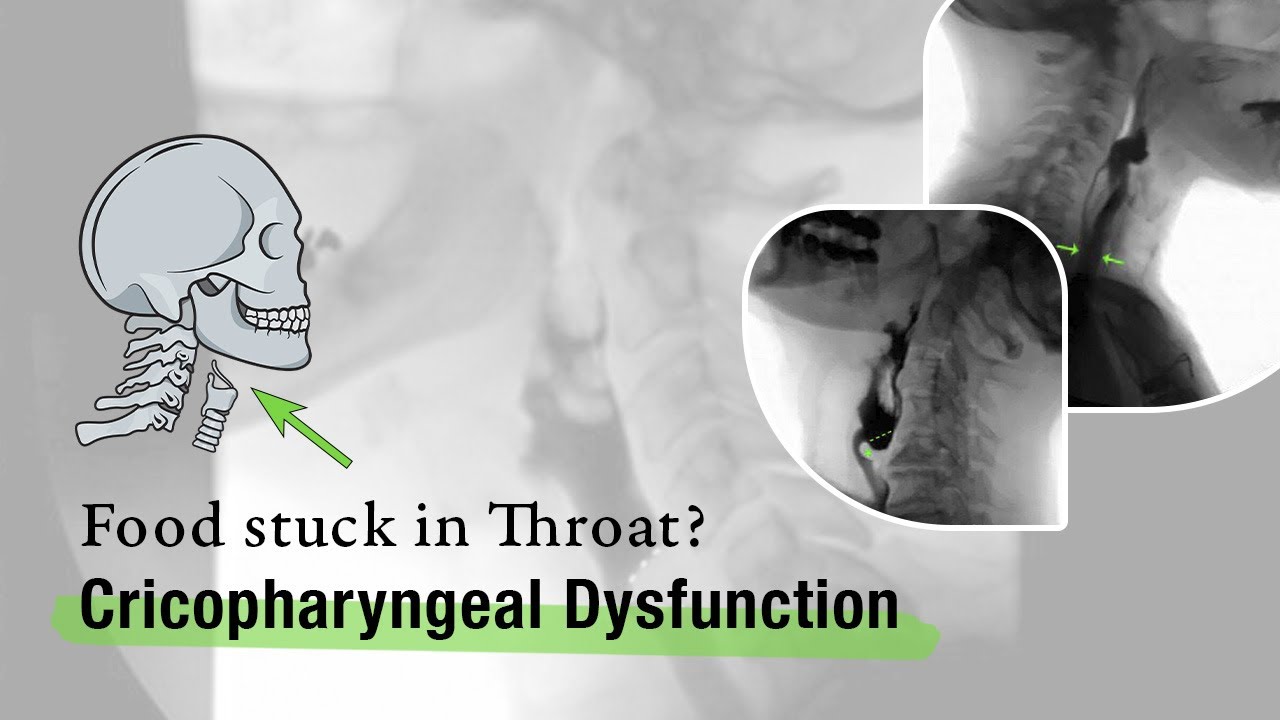 Cricopharyngeal Dysfunction: Before and After Cricopharyngeal Myotomy