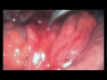 Thumbnail 1 for Apendicitis Aguda Evolucionada. Tratamiento Laparoscópico Thumbnail 1 for Apendicitis Aguda Evolucionada. Tratamiento Laparoscópico