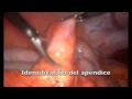 Thumbnail 2 for Apendicitis Aguda Evolucionada. Tratamiento Laparoscópico Thumbnail 2 for Apendicitis Aguda Evolucionada. Tratamiento Laparoscópico