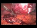 Thumbnail 3 for Apendicitis Aguda Evolucionada. Tratamiento Laparoscópico Thumbnail 3 for Apendicitis Aguda Evolucionada. Tratamiento Laparoscópico