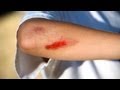 How to Treat a Cut or Graze - First Aid for Grazes & Cuts – OCDTac