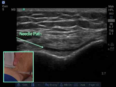 Dr Steven Sampson demonstrates Ultrasound Guided Knee Injection - YouTube
