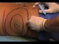 Video: DrTowhidian LASER LIPOSUCTION PART2.wmv