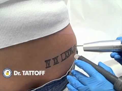 tattoo removal lower back laser tattoo removal dr tattoo removal lower back laser tattoo removal dr
