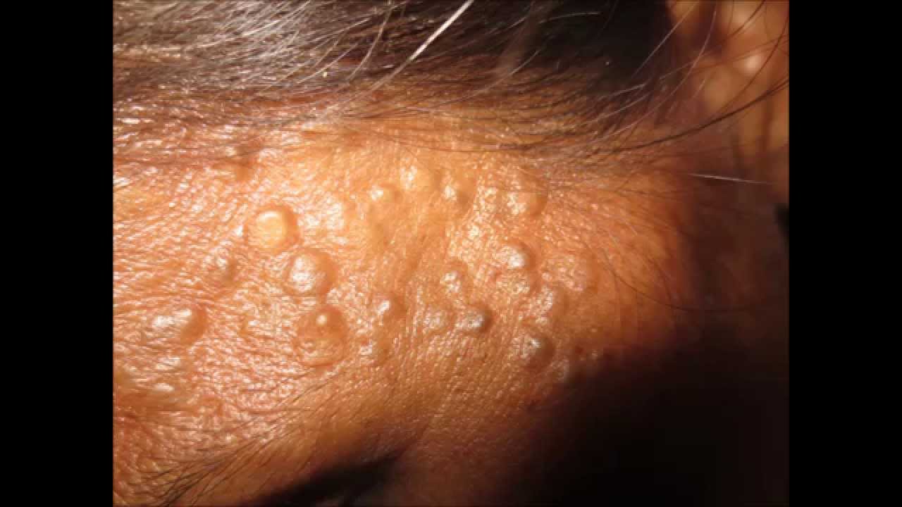 clusters of bumps on skin