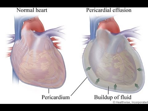 heart fluid retention