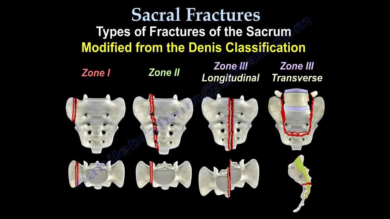 Sacral Fractures - Everything You Need To Know - Dr. Nabil Ebraheim