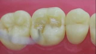 Restauración dental con Resina