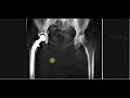 Interpreting X-Rays of the Pelvis, Hip Joint and Femur