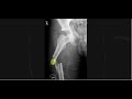Interpreting X-Rays of the Pelvis, Hip Joint and Femur