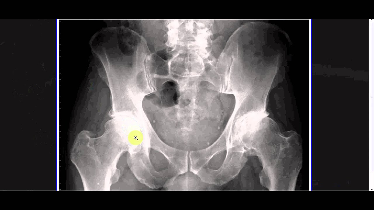 Interpreting X-Rays of the Pelvis, Hip Joint and Femur - YouTube