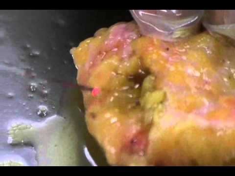 Plazmalipo Plasmalipo Human fat melting 20W - YouTube