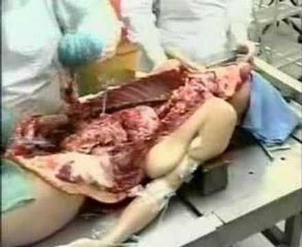 YOUTUBE VIDEO AUTOPSIA DE VALENTIN youtube video autopsia de valentin: