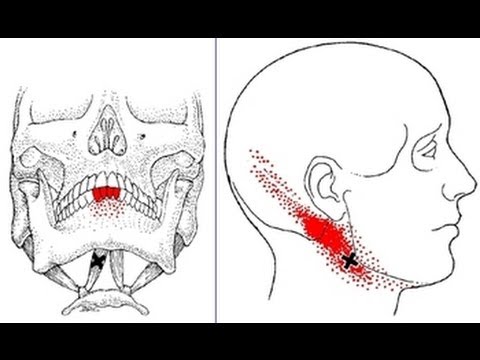 Jaw, Neck, Head, and Teeth Pain from Digastric Muscle Trigger Points