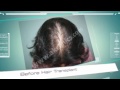 Watch Video Ak Clinics Hair Transplant Patient Results ( 12 months )