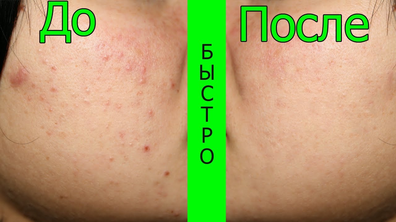 Вся спина в прыщах и следах отзывы Вся спина в прыщах и следах отзывы