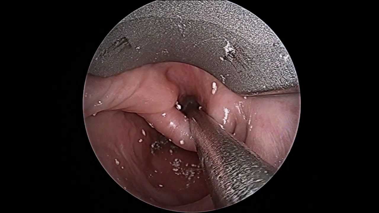 Zenkers Diverticulum Prior to Endoscopic Repair YouTube