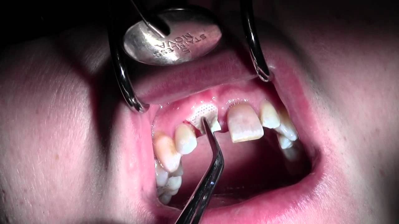 Bone Grafting 8, dPTFE Membrane Removal at 28 days YouTube